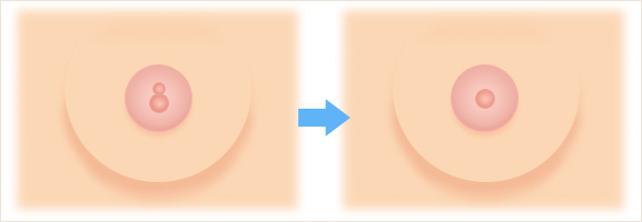 分裂乳頭の手術方法