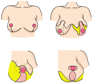 乳房縮小術