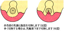 乳房縮小術・乳房固定術の手術方法
