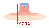 乳頭縮小術の手術方法