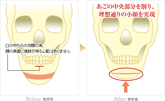 施術前:口の中からの切開の為、顔の表面に傷跡が残る心配はありません。施術後:あごの中央部分を削り、理想通りの小顔を実現。