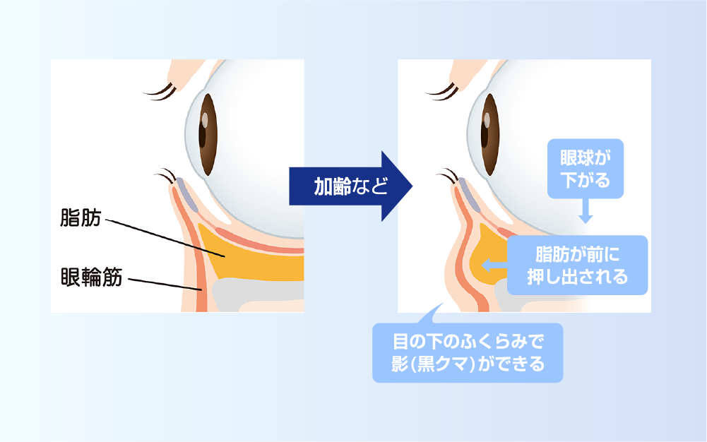 黒クマの発生メカニズム