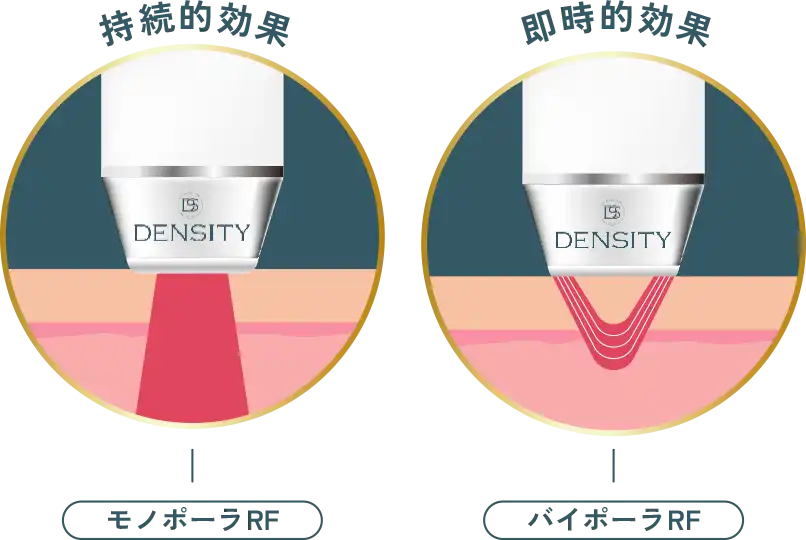モノポーラRF（深層）とバイポーラRF（浅層）